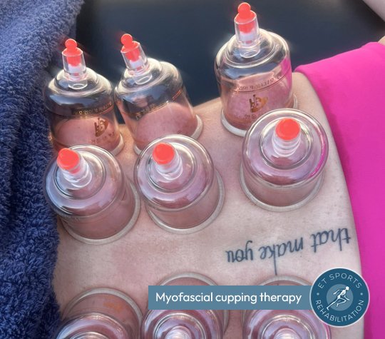 myofascial cupping for sports