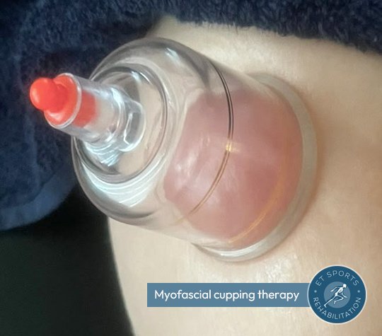myofascial cupping treatment